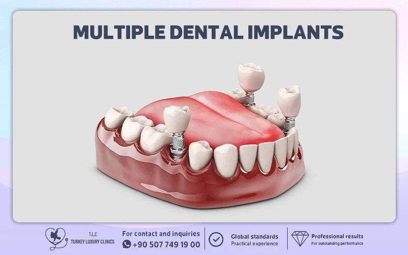 Cost of Multiple Dental Implants in Turkey
