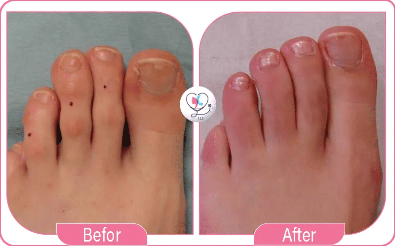 مضاعفات عملية تجميل أصابع القدم