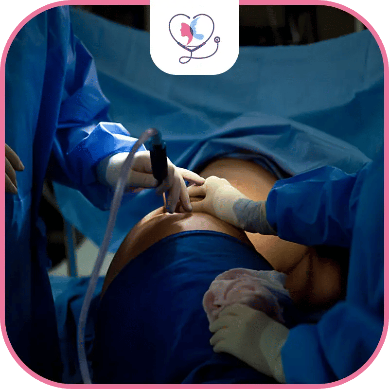  فشل عملية شد ترهلات الظهر