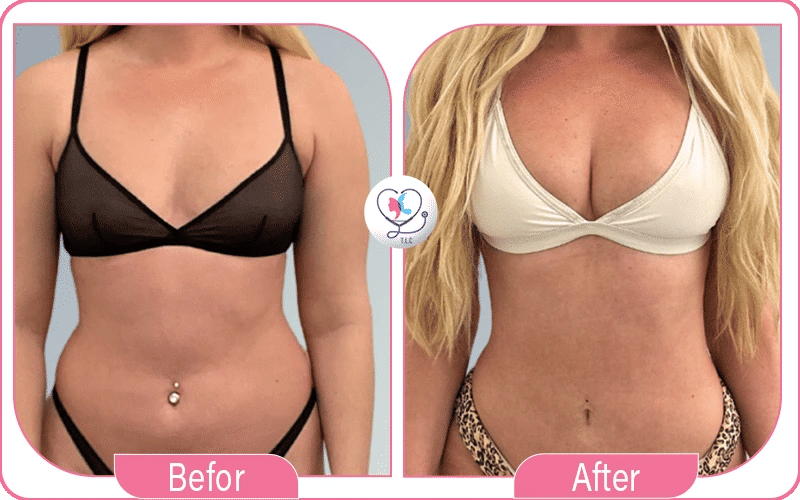 Avant / Après lipofilling mammaire du résultat du lipofilling mammaire-3