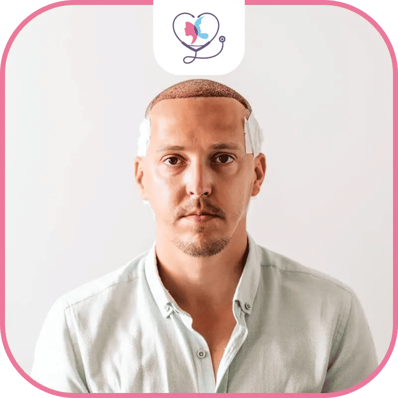 كيفية تجنب مضاعفات زراعة الشعر