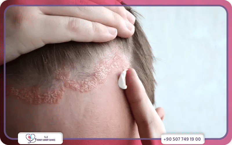 علاج صدفية الشعر في المنزل