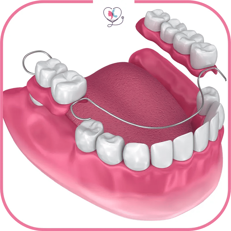 processus de pose bridge dentaire
