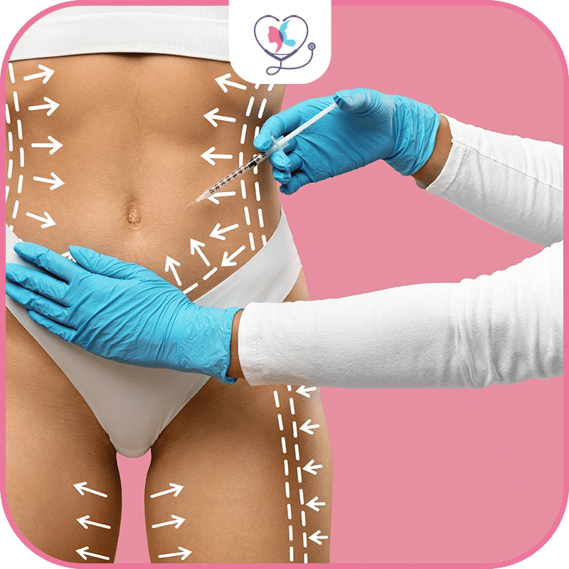 liposuccion 360 avant après