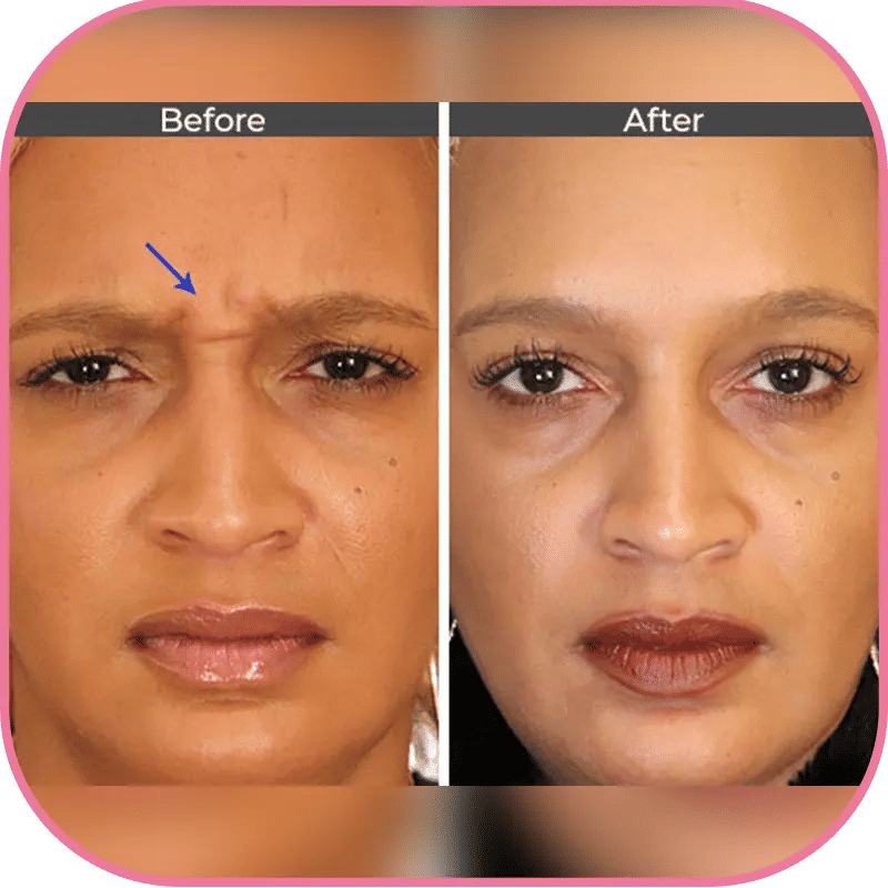 Botox Injection Before and After Photos 2
