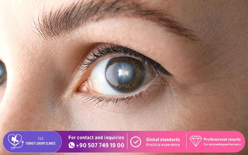 Can I Develop Cataracts After ICL?