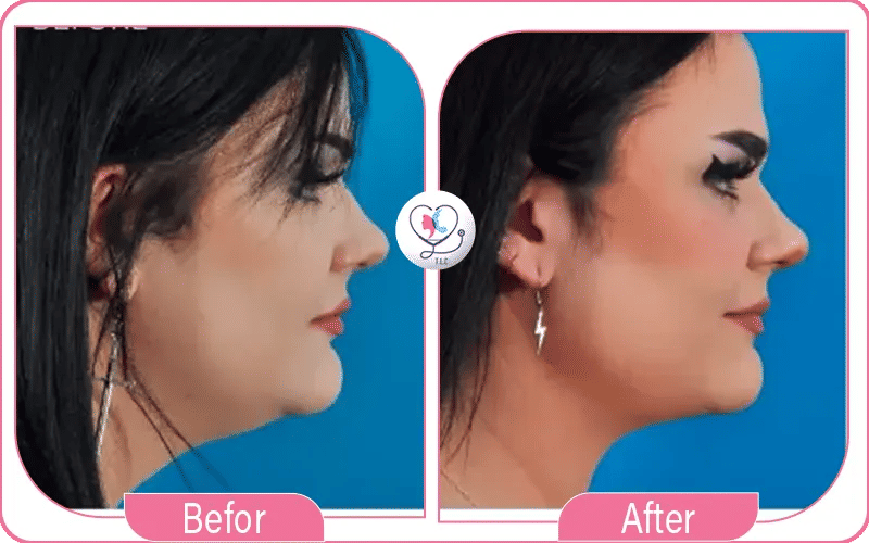 مميزات شفط اللغلوغ بالليزر