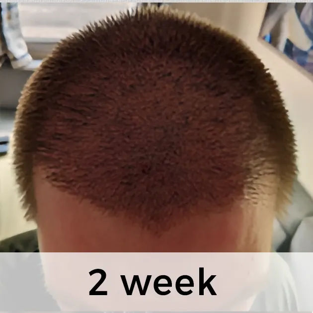 Hair Transplant Week by Week: From Week 1 to Week 48 