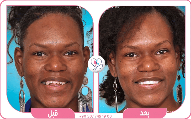 عضة مفتوحة أمامية