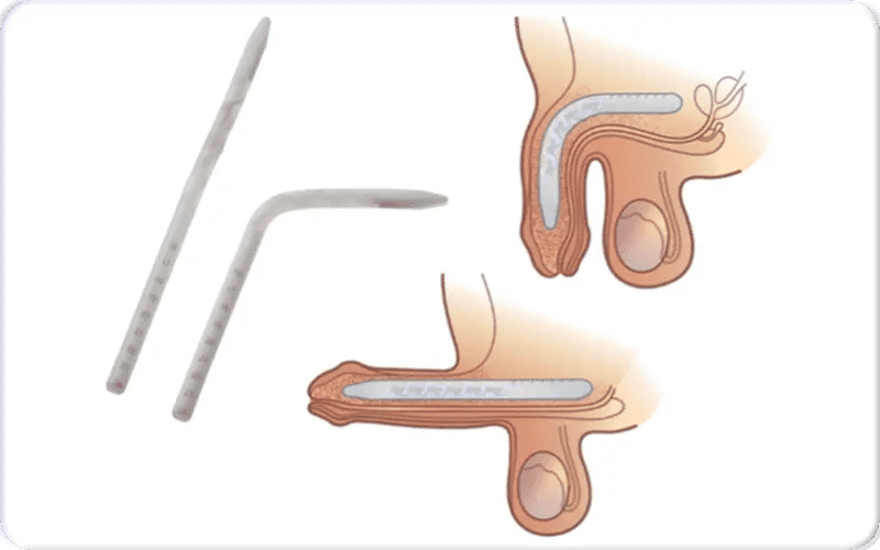 شكل الدعامة المرنة