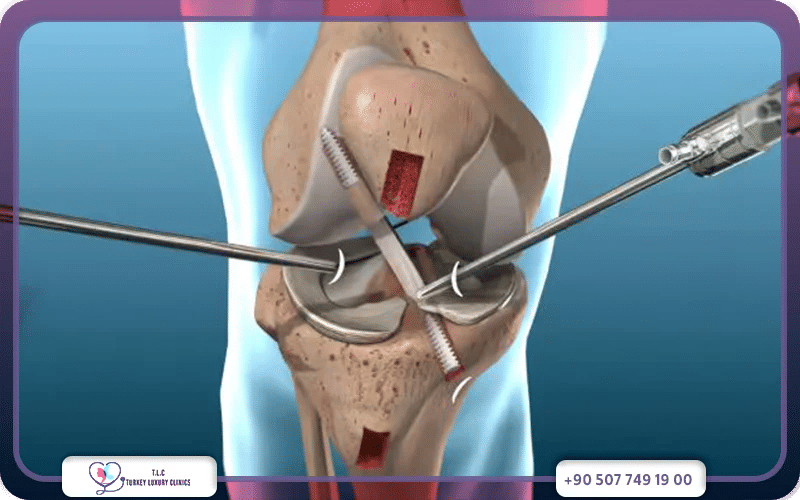 أضرار ومضاعفات عملية الرباط الصليبي بالمنظار 