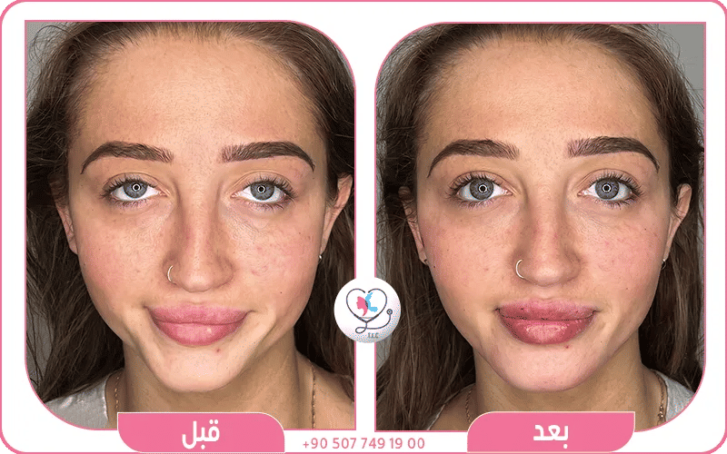 أضرار فيلر الذقن المؤقتة والجانبية