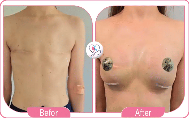 Pourquoi choisir une reconstruction mammaire ?