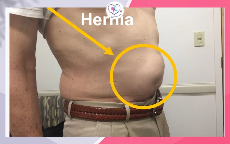 الفتق الجراحي (Incisional Hernia)