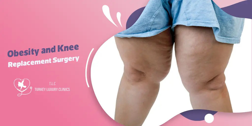 Obesity and Knee Replacement: How it can Impact?