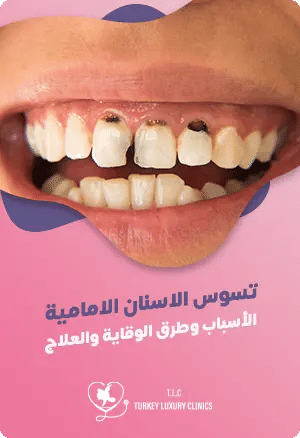 تسوس الاسنان الامامية: الأسباب وطرق الوقاية والعلاج المناسبfeatured image