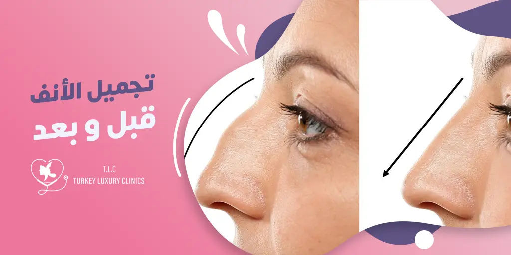 عمليات تجميل الانف قبل وبعد