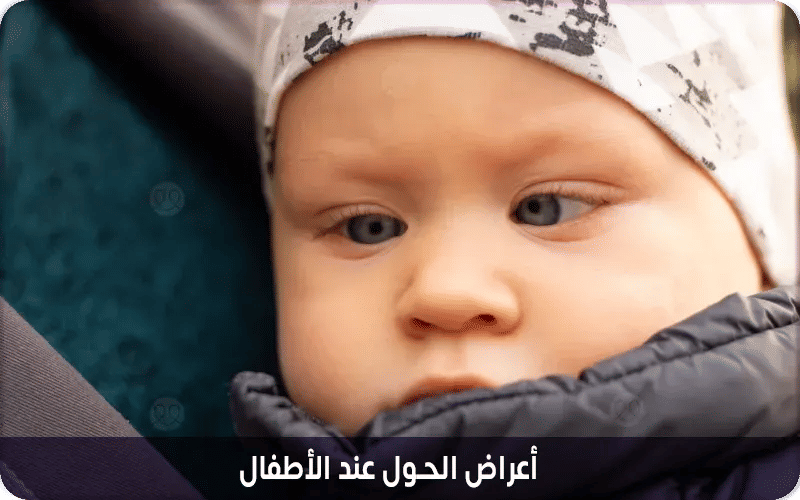 أعراض الحول عند الأطفال