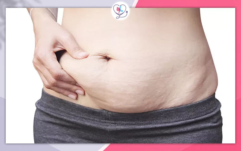 كيف اخترت تركيا لإجراء تجربتي مع عملية شد البطن؟