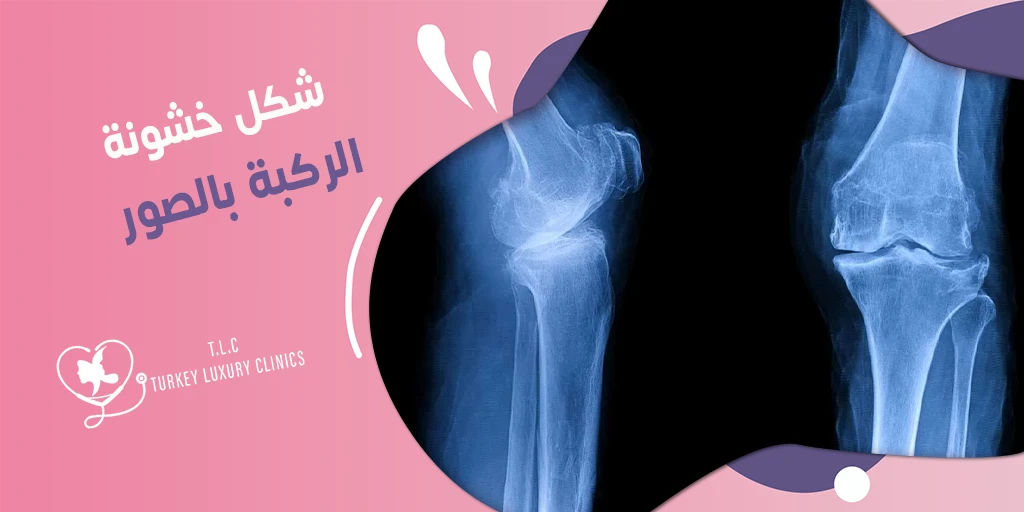 شكل خشونة الركبة بالصور: فيديو يشرح التفاصيل والتشخيص