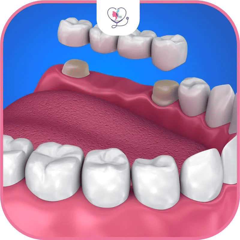 types de ponts dentaires