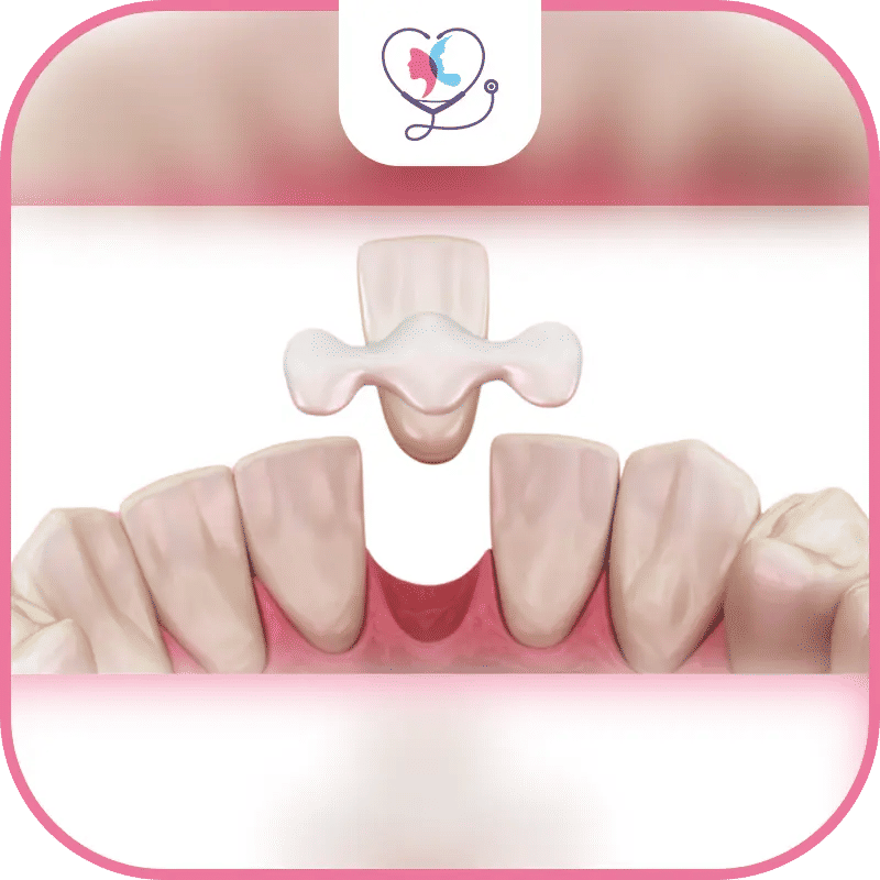 أسباب تركيب جسور الأسنان