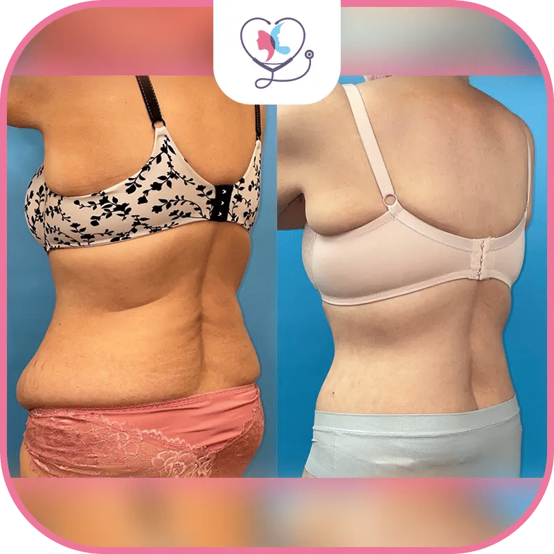 عملية شد الظهر قبل وبعد