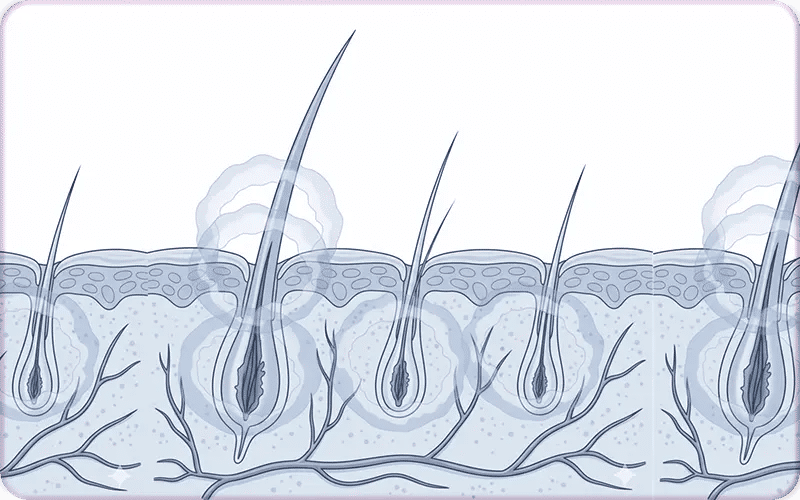 Qu'est-ce que l'alopécie androgénétique, la cause principale de la calvitie ?