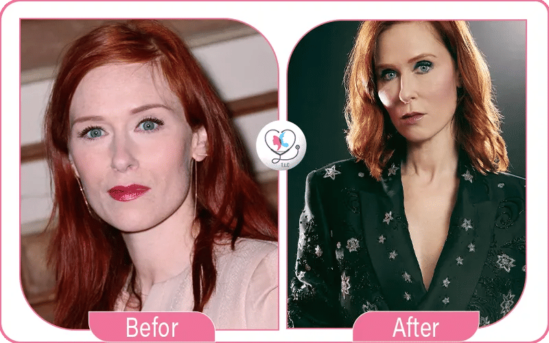 Audrey Fleurot avant / après chirurgie-2