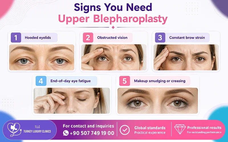 Signs You Need Upper Blepharoplasty