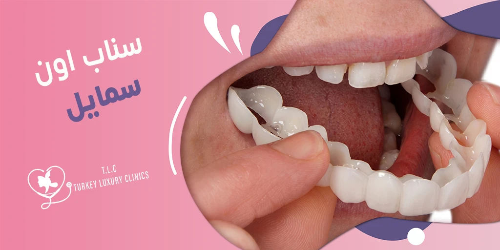 سناب اون سمايل: هل هي مناسبة لك؟ وماهي الأنواع والأسعار؟