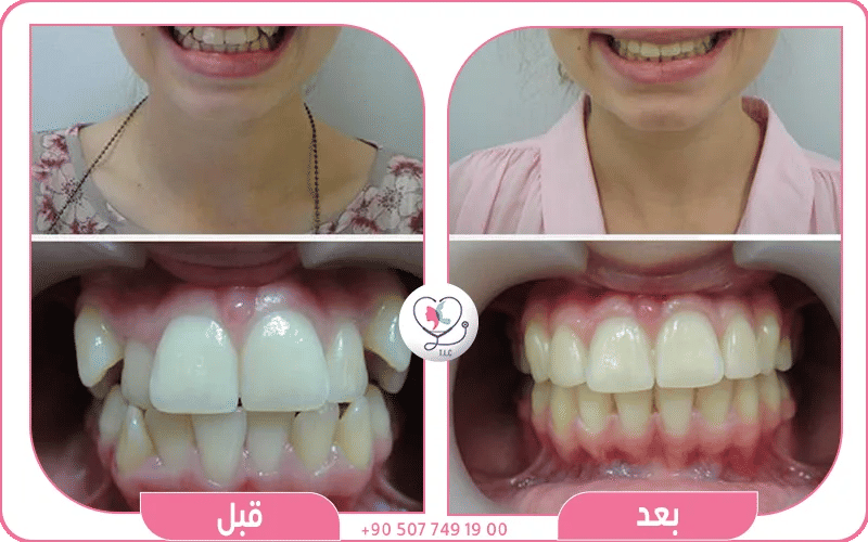 ازدحام بسيط في الأسنان الأمامية