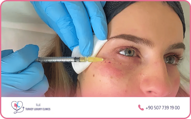 Le PRP (Plasma Riche en Plaquettes)