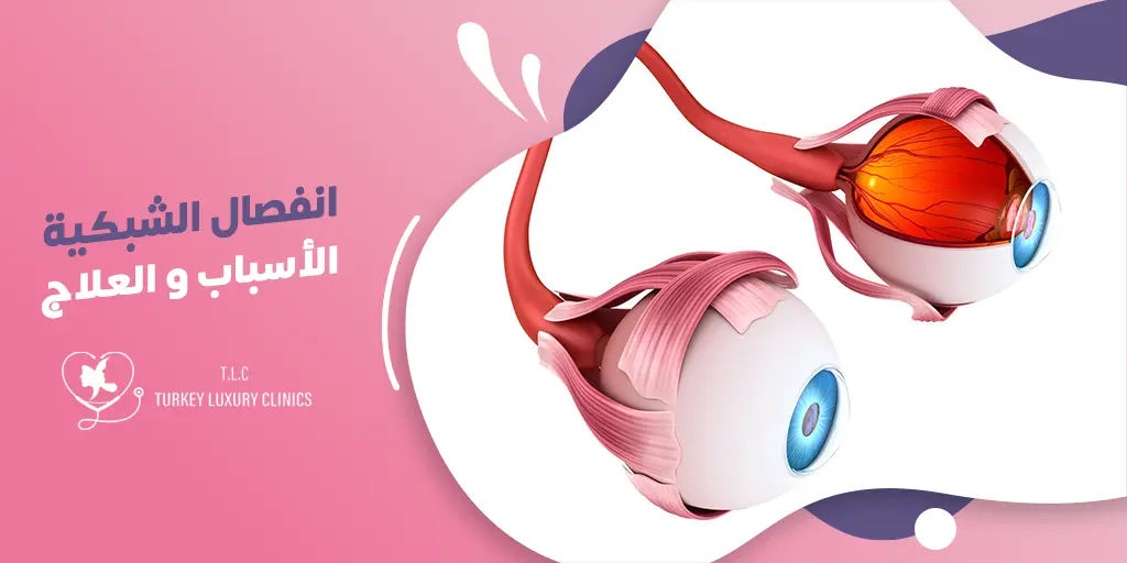 علاج انفصال الشبكية في تركيا