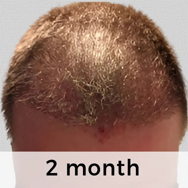 Hair Transplant Week by Week: From Week 1 to Week 48 