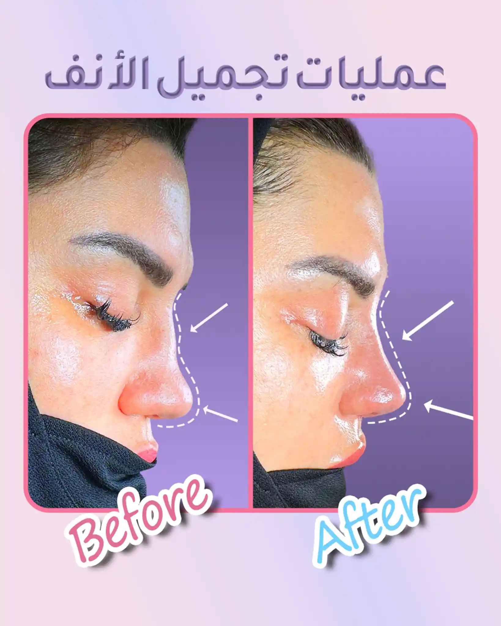 نسبة نجاح عملية تجميل الأنف