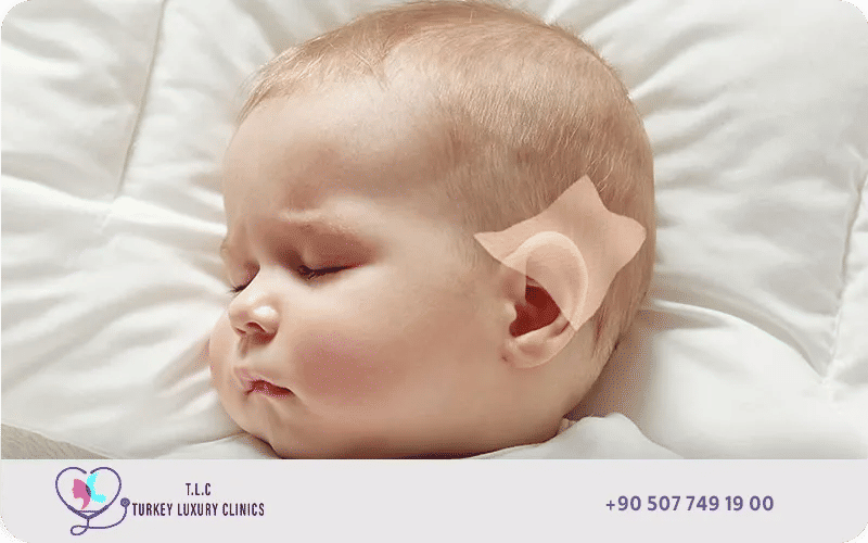 علاج الأذن البارزة في المنزل للرضع
