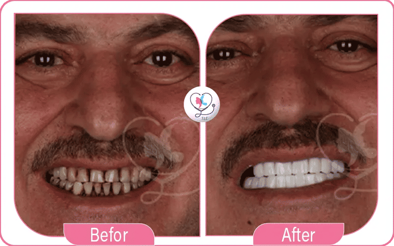 العوامل المؤثرة على تكلفة زراعة الأسنان في تركيا