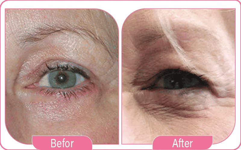 تدلي الجفن المكتسب