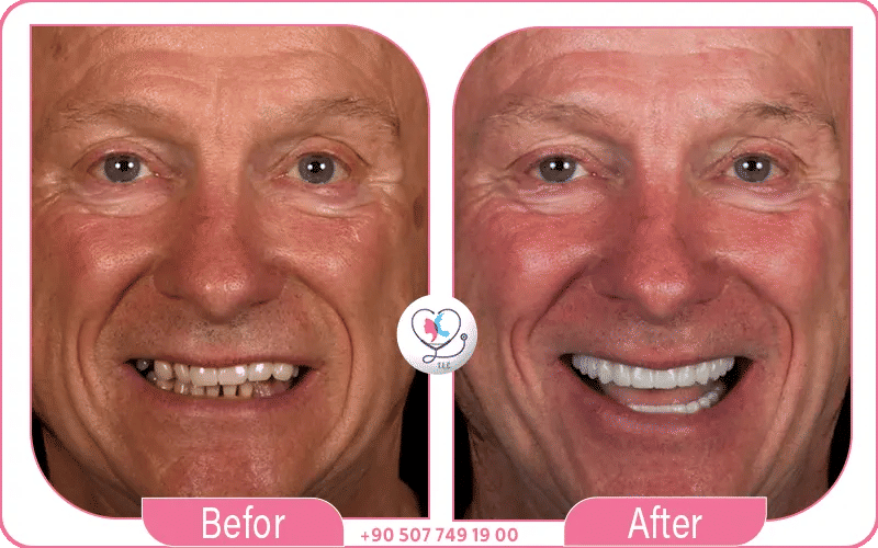 Pourquoi choisir turkey luxury clinic pour implant dentaire all on 6