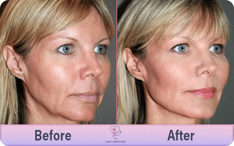 دواعي اللجوء لشد الوجه بالخيوط