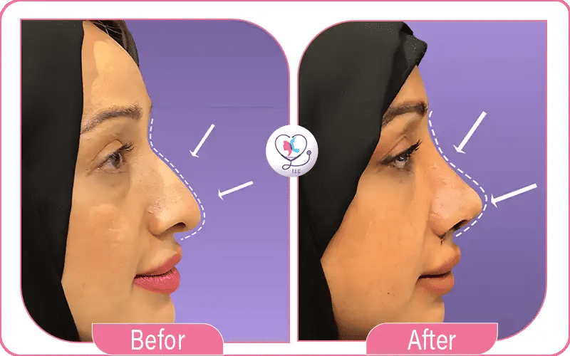 شكل ارنبة الأنف بعد العملية مع الوجه