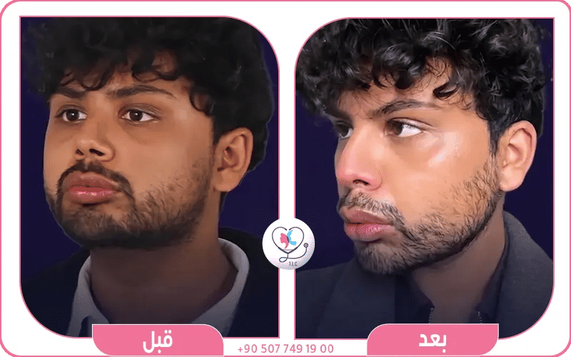 عملية ازالة دهون الخد