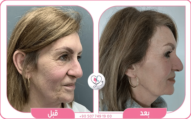 ابرة البروفايلو قبل وبعد