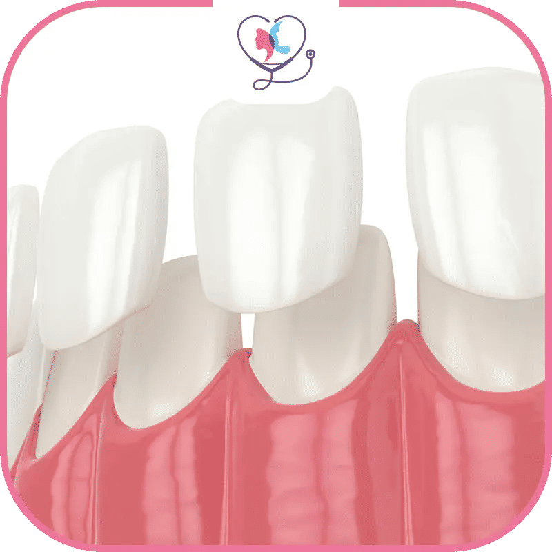 ما هي أسعار قشور الأسنان في تركيا؟