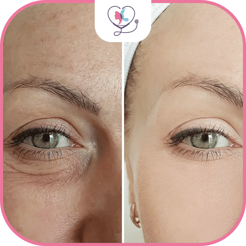 عملية شد الجفون في تركيا