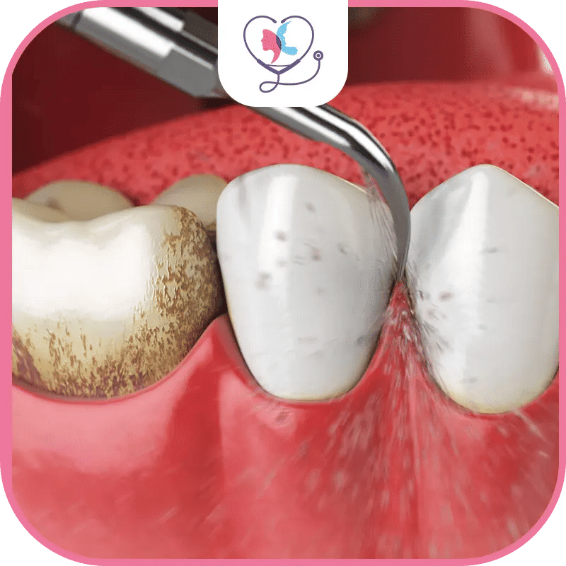 فوائد تنظيف الأسنان في تركيا