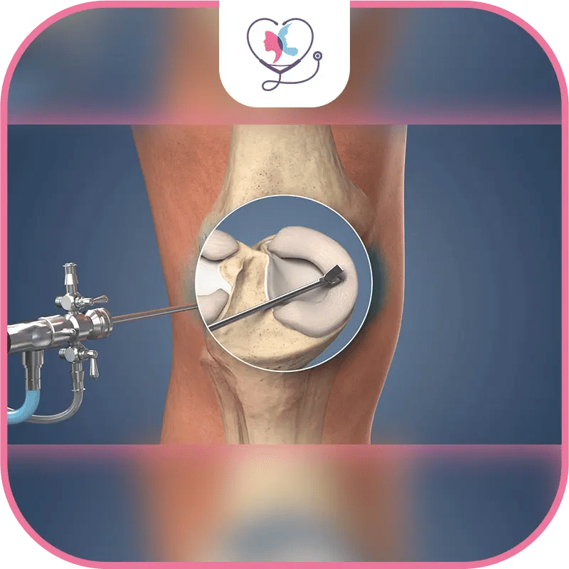 Procédure d'arthroscopie et d'arthroplastie du genou