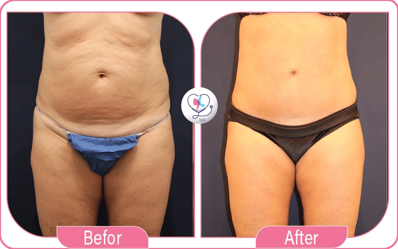 Changes of the Belly Button During Tummy Tuck Surgery