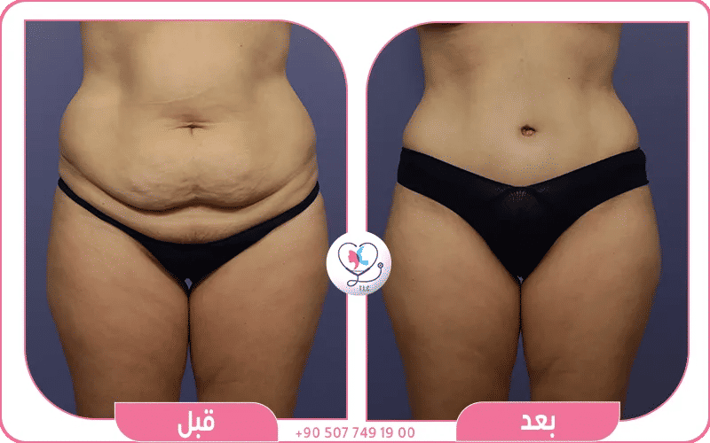 علاج ترهل البطن بالجراحة